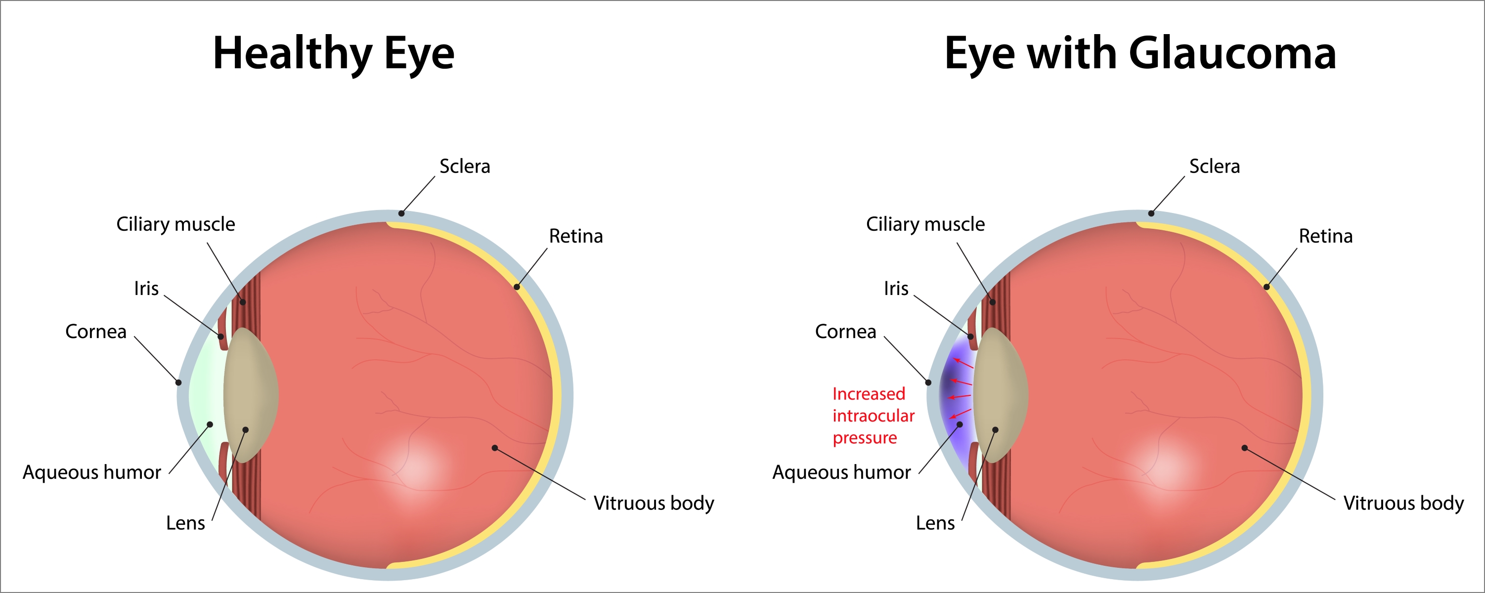 closed angle glaucoma vs open angle